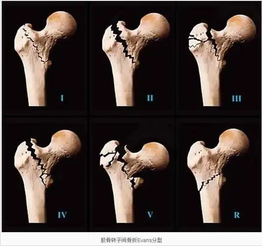 老年人摔倒致股骨转子间骨折(股骨粗隆间骨折)怎么办? - 好大夫在线