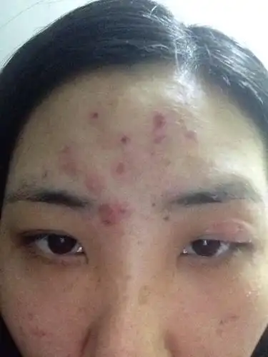 本月初在医院做的微晶磨消治疗的扁平疣,现在结痂已经掉了,但是肉是