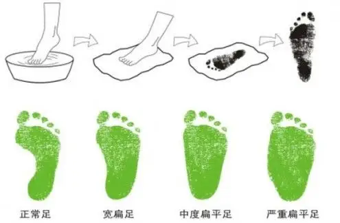 水印法自测扁平足,如患扁平足可穿矫正鞋干预