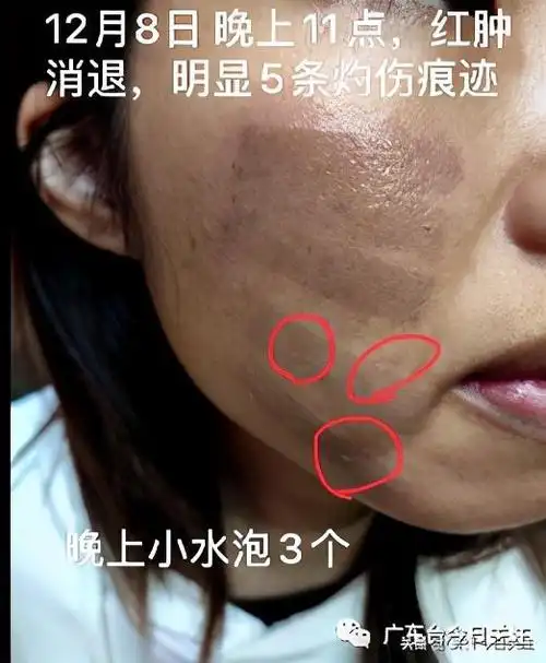 女子做完光子嫩肤右脸被烫出五道杠