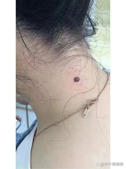 脖子大肉痣