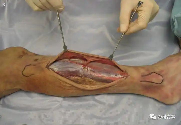 图解小腿骨筋膜室综合征单切口减压技术