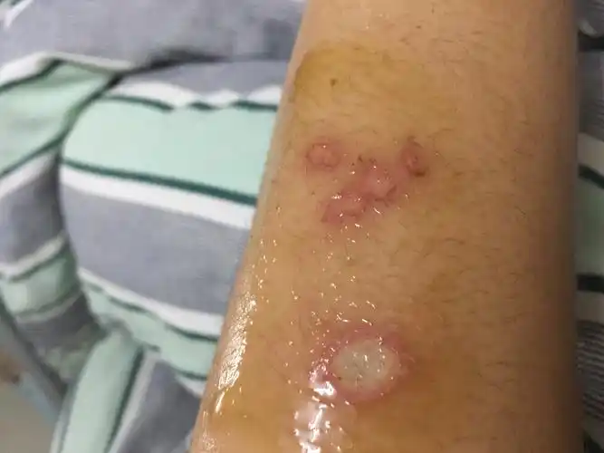 不小心被烟头烫伤我要怎么处理才是疤痕不那么明显