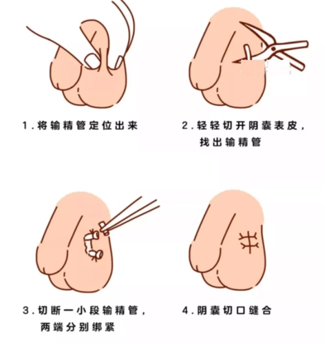 男性结扎的原理是什么 男性结扎的原理介绍