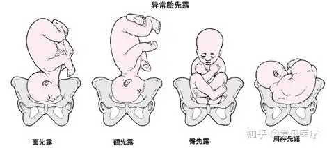 哪些胎位属于胎位不正