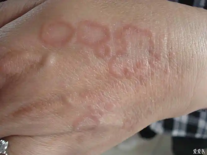 本病的治疗 - 皮肤及性传播疾病讨论版 - 爱爱医医学论坛