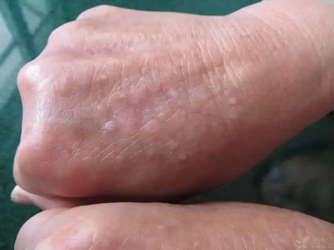 【求助】手背这皮疹是扁平疣还是扁平苔藓
