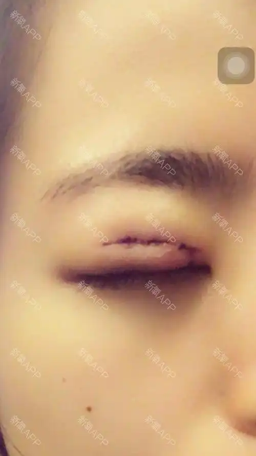昨天刚刚做的双眼皮.感觉大家都切的很长到眼尾.我这个只有三分之 ..