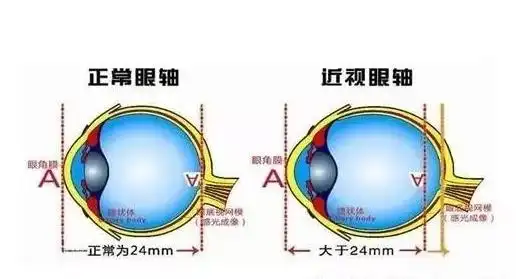 近视眼图片