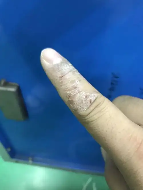 我手指上皮肤干裂,快一年了