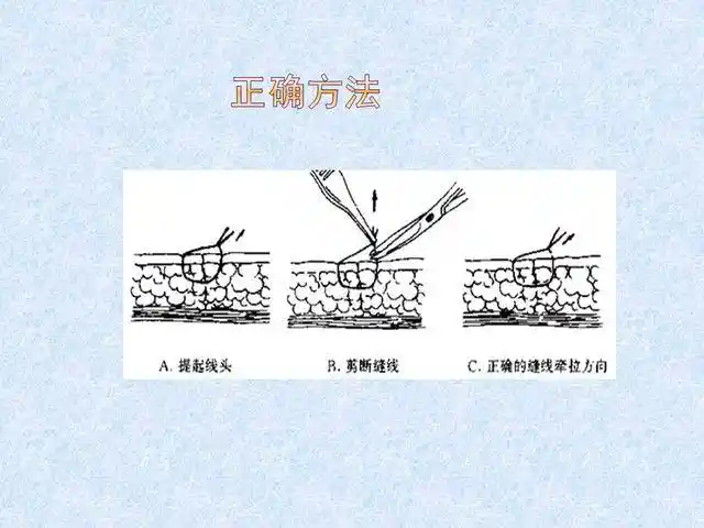 换药,拆线及伤口包扎技术