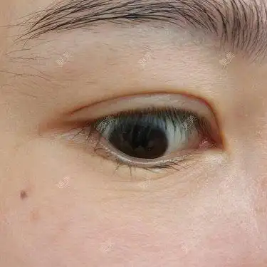 我想请问一下像我这种眼纹该怎么去除