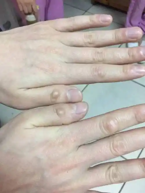 技师手上长老茧又疼又肿怎么办