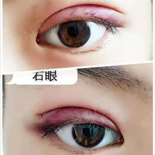 双眼皮第3页_眼部整形第3页_shine 分享图片8