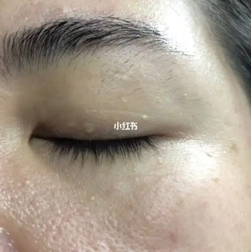 眼睛这几颗是扁平疣吗?用什么能消?