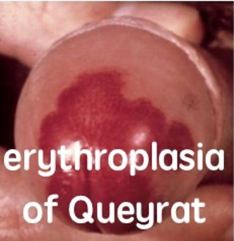 欧洲龟头炎/龟头包皮炎诊疗指南解读 3 —— 肿瘤因素【图片可能引起