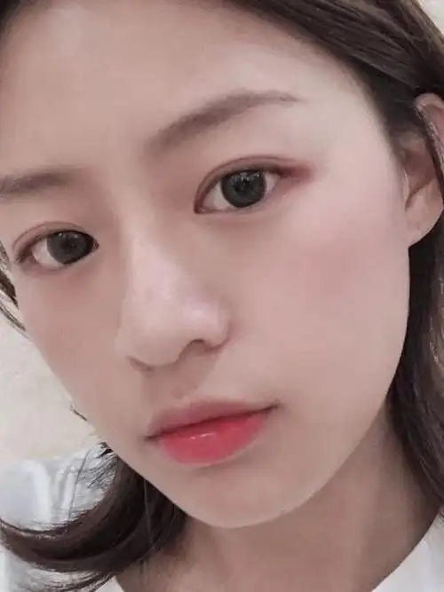 做了7mm的双眼皮,开扇形的,看起来应该比较小清新_圈子-新氧美容整形