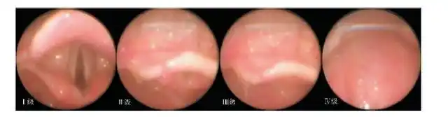 c:甲状软骨上窝至下颌舌骨处大于2指 注:Ⅰ级:可见软腭,咽腔,悬雍垂