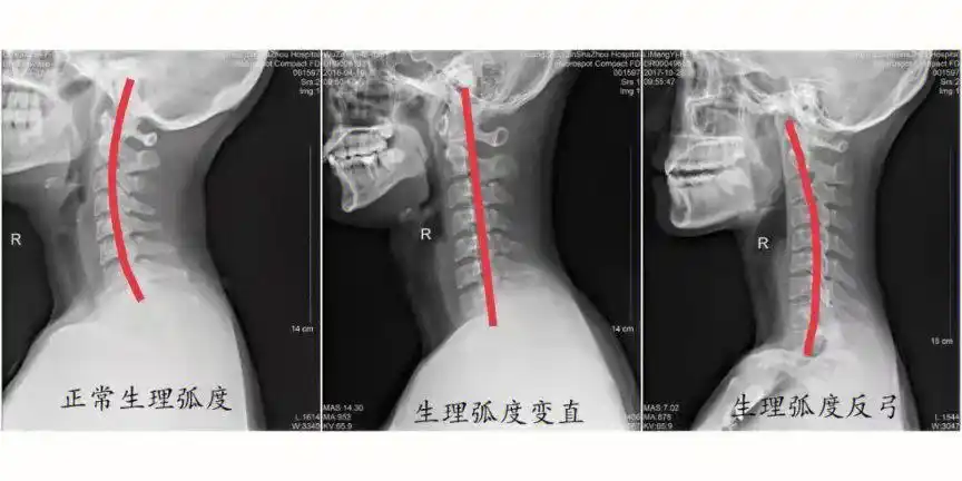 让你明白颈椎曲度