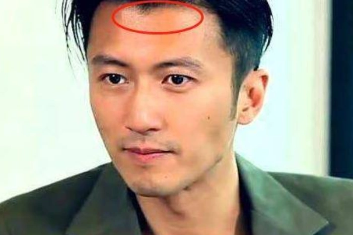 美人尖发际线怎么修