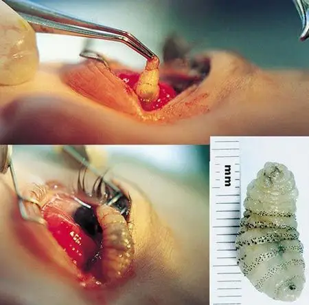 中国有寄生在眼睛的苍蝇吗