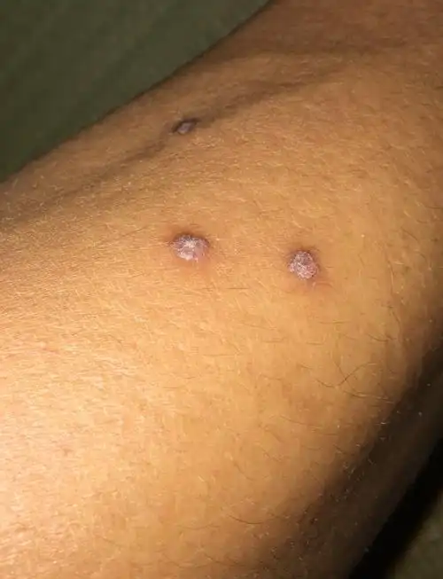 患者男今年52岁两年前颈后开始长两个瘊子其中一个较大已