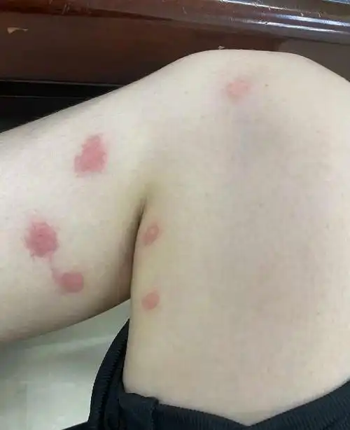 暗红色的斑疹,皮肤过敏者会面积更大中心有明显红点及跳蚤叮咬的口器