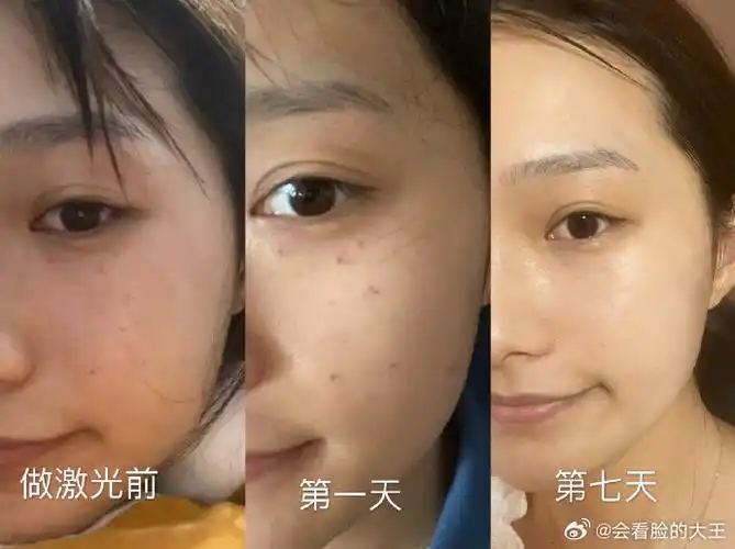 南京激光祛斑分享