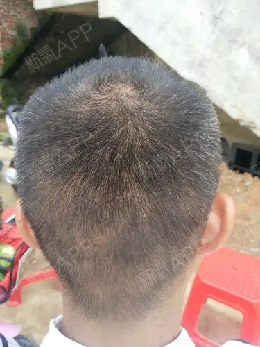 这段时间头发已经长长了不少,后脑勺取发区基本上都恢_圈子-新氧美容