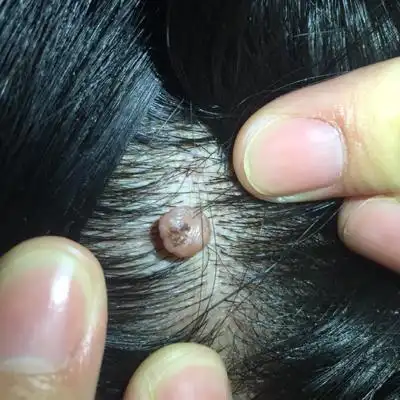 宝宝百天,作为宝妈的我,头皮上长了一个肉疙瘩,几年前有,现在变大了