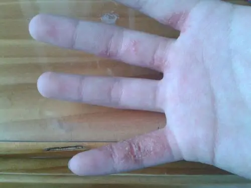 手部像藓一样 晚上很痒 早上起来 会发现肉都被自己抓破了 时间不清楚