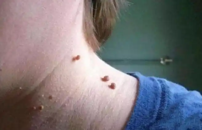 脖子上的丝状疣传染的越来越多别害怕丝瓜叶盐一抹就掉了