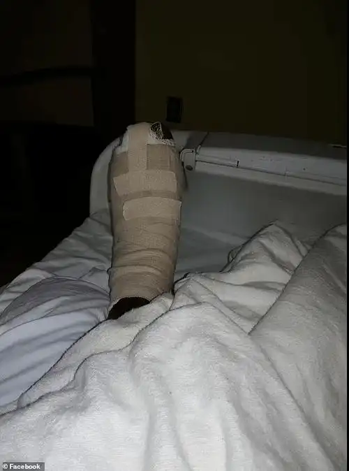 医生给她做了脚趾截肢手术,但她的感染实在太严重了,截肢后情况仍然在