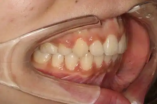 如何以最低时间成本拯救轻微龅牙?