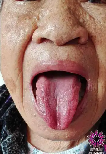 85岁老人尿频,高血压,腿脚无力及胆囊炎气冲病灶拍打急救