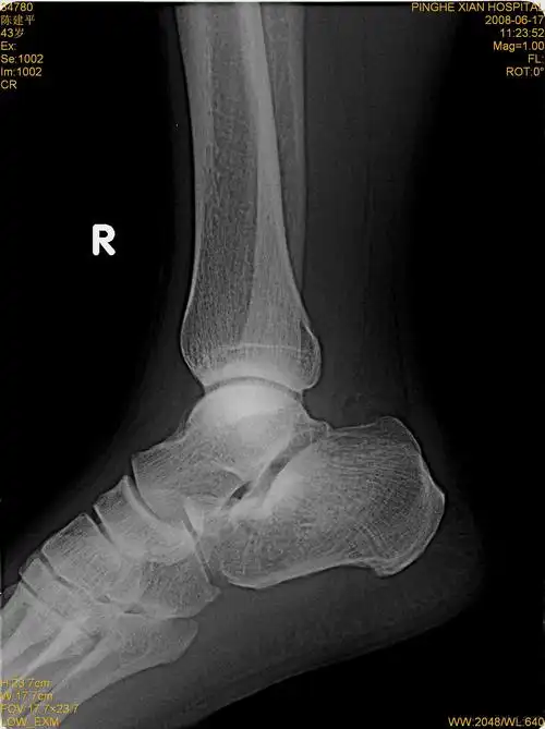 右足跟骨骨折