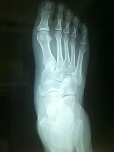 打球崴脚了 麻烦看一下x片