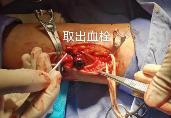 透析用动静脉内瘘取栓_尿毒症 - 好大夫在线