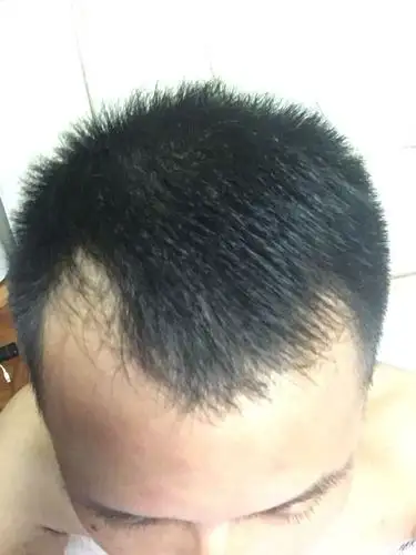 30岁,两额头发已经秃成这样,怎么办?