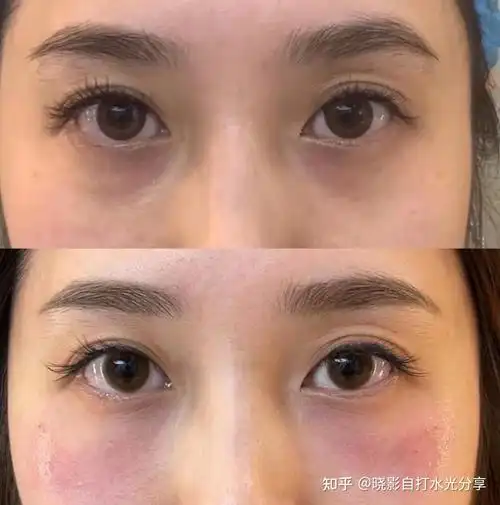 泪沟填充用什么好 怎么改善去除