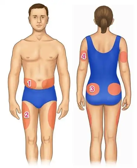 糖尿病系列: 胰岛素注射部位有哪些?