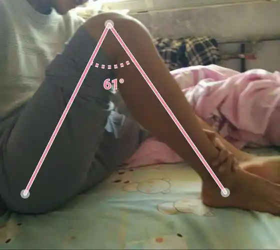 大夫您好,我现在手术完23天,基本上没怎么掰腿就到了120度_袁锋_副