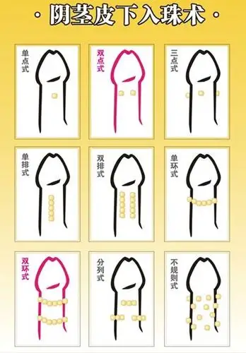 阴茎入珠是怎么回事