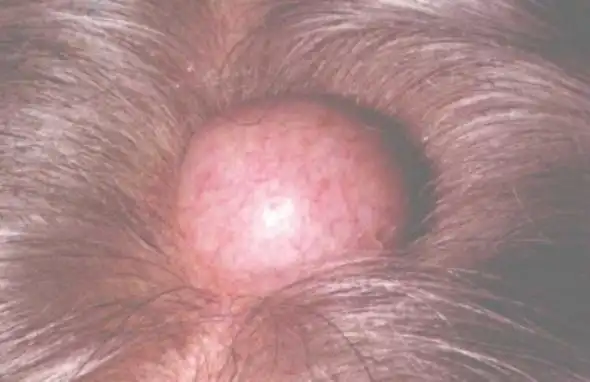 皮脂腺囊肿多发生于头皮,也叫做毛发囊肿(如下图).