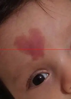 胎记的位置与命运「十大不好的胎记位置」  第1张