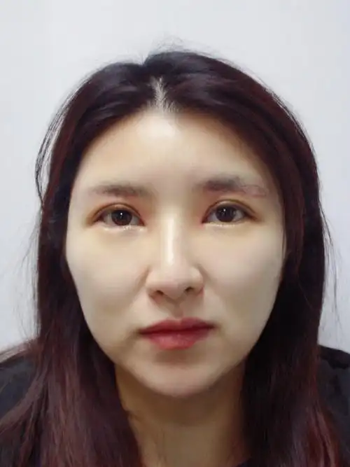 内眼角开大术后七天,天生的内眦赘皮,非常影响美观96_圈子-新氧美容