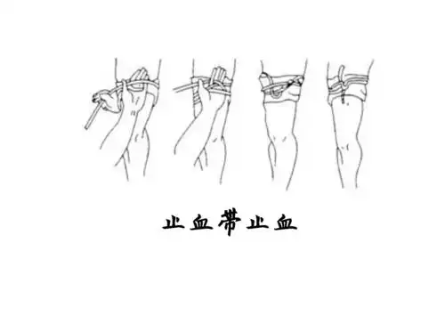 动脉大出血必要时使用止血带止血法.