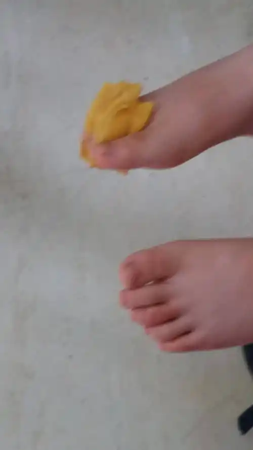 湿疹图片初期症状图片,?脚上为什么会长湿疹