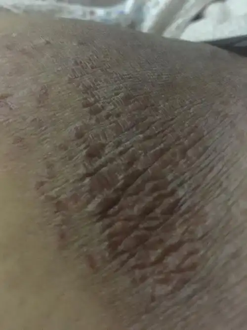 在大腿内侧这是股藓还是湿疹