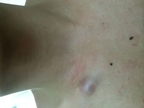 右锁骨上这个是淋巴结吗右手动作大会有点痛压痛比昨天肿大